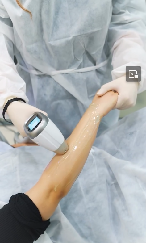 Épilation Laser